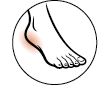 Plantar fasciitis